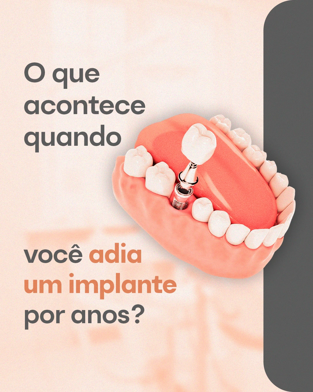 Após a perda de um dente, o osso da região pode diminuir com o tempo por falta de estímulo.